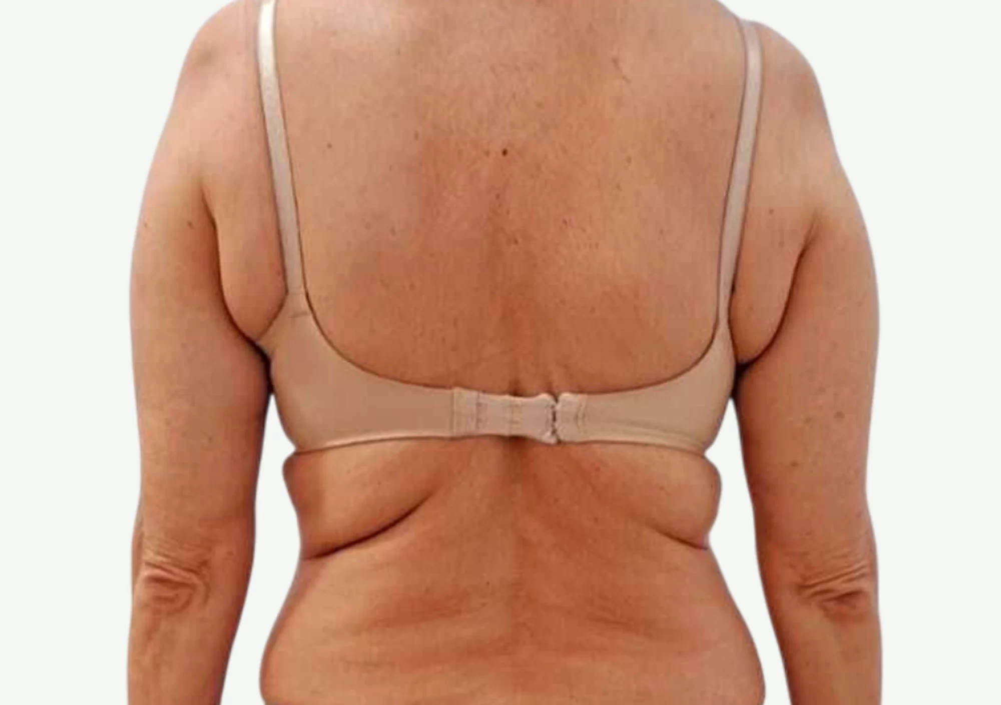 Presoterapia