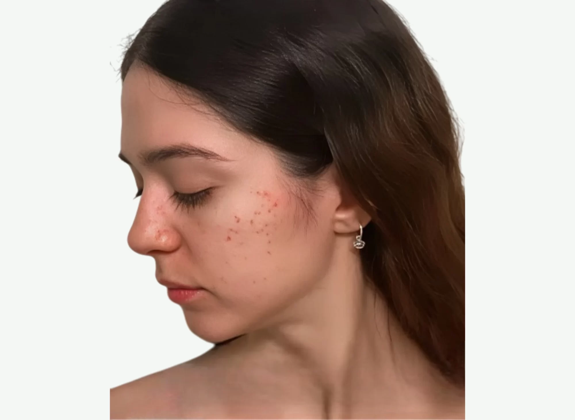 Dermapen-A