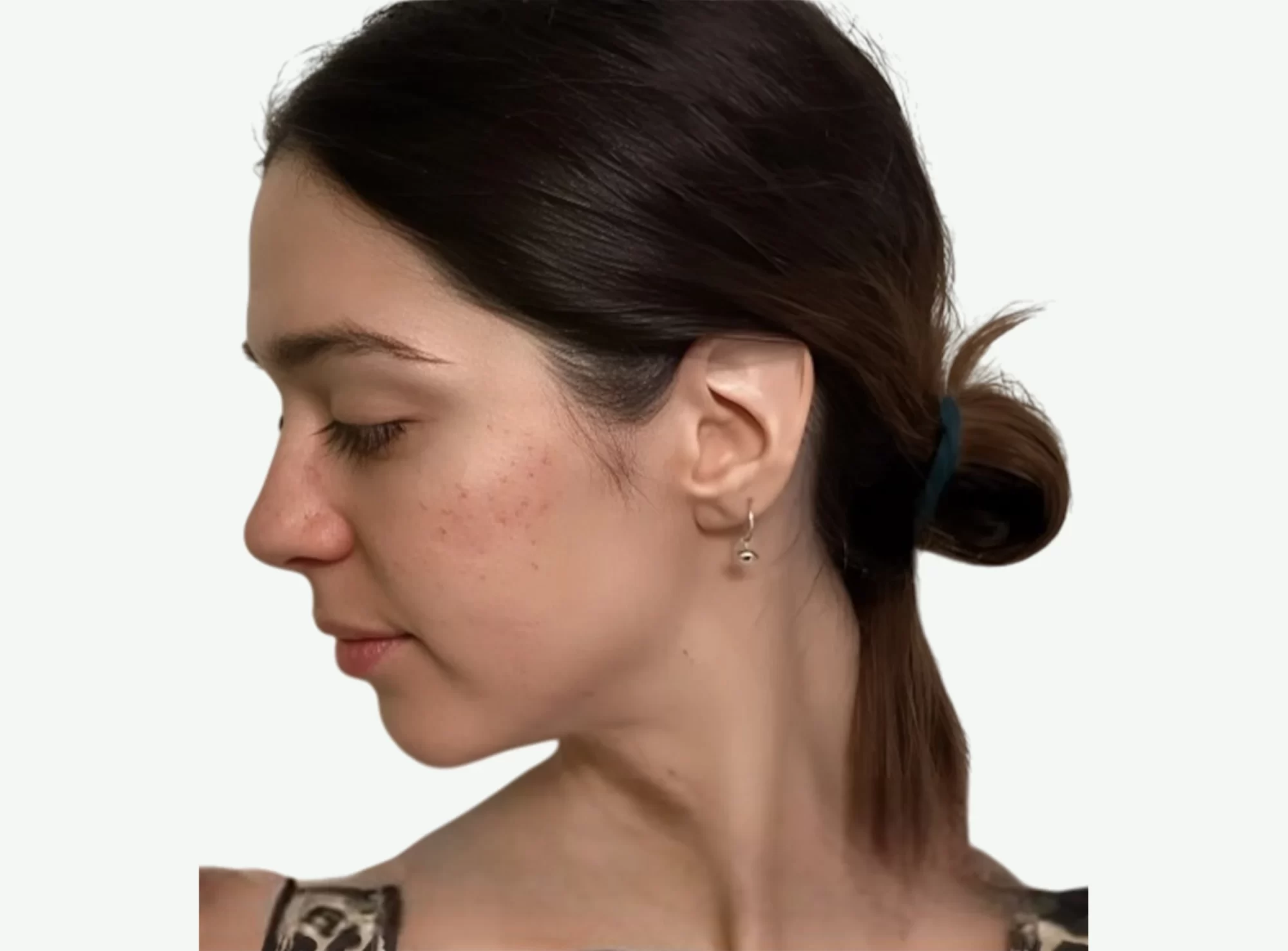 Dermapen-D