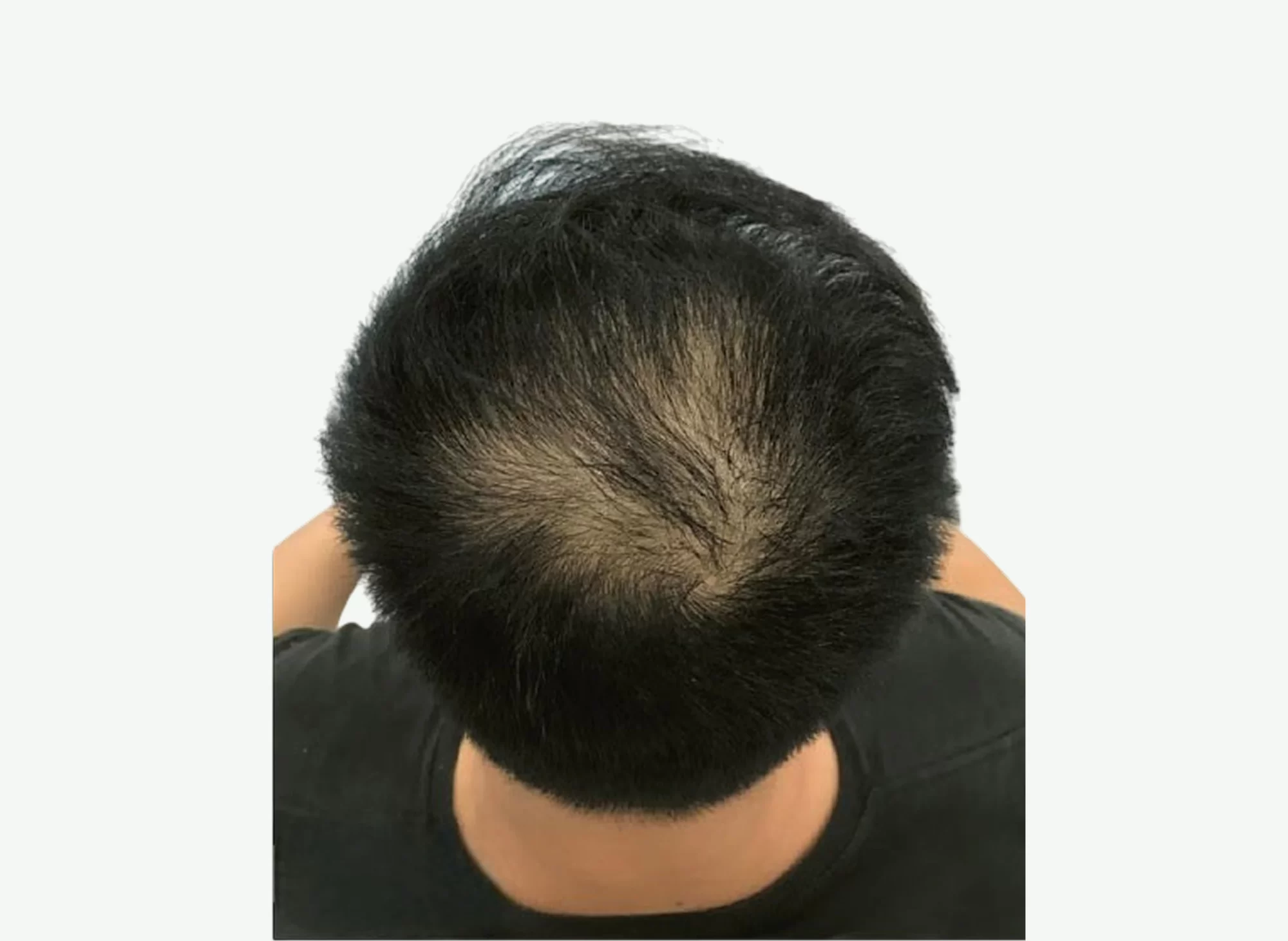 caida del cabello-A