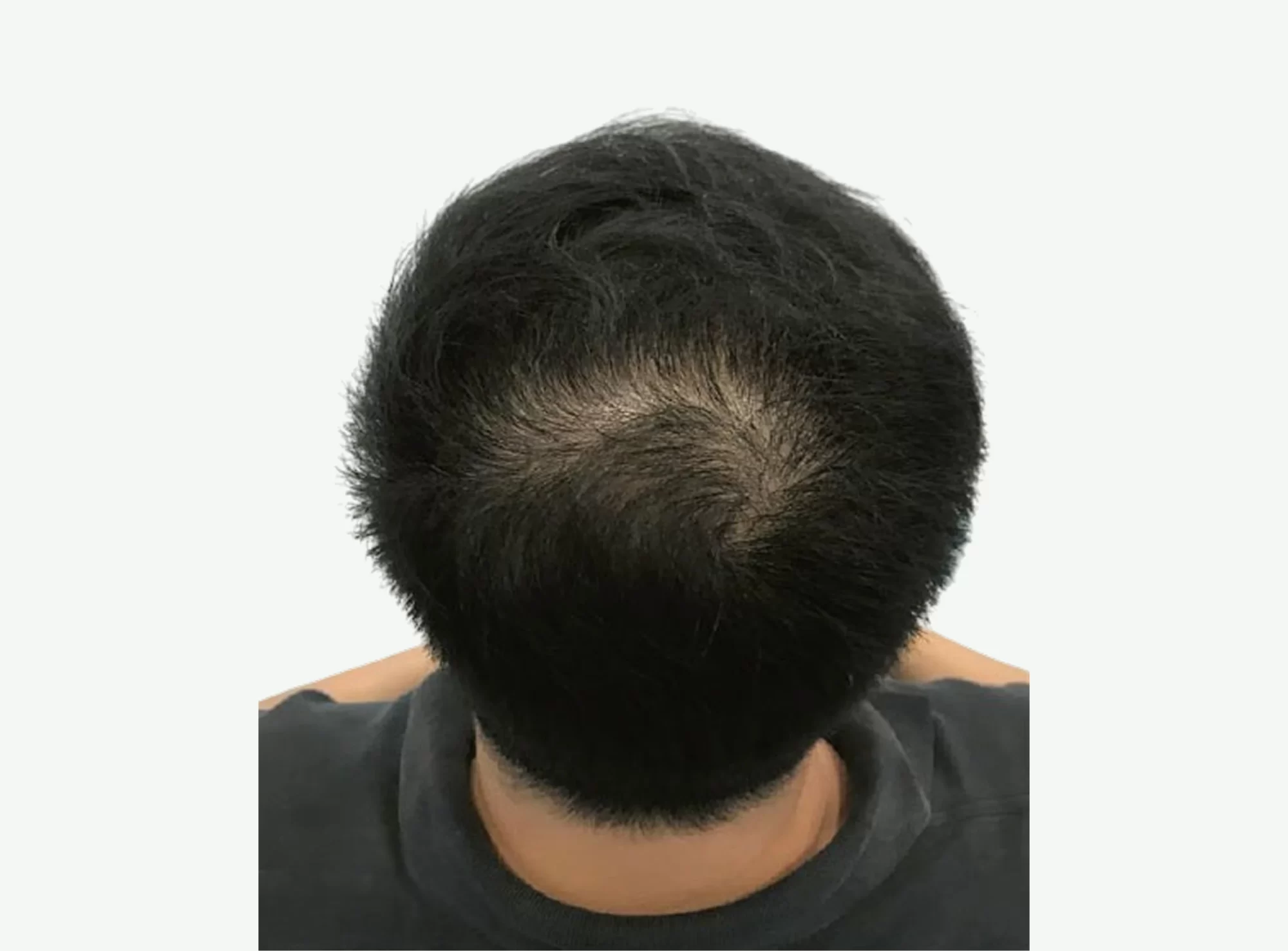 caida del cabello-d