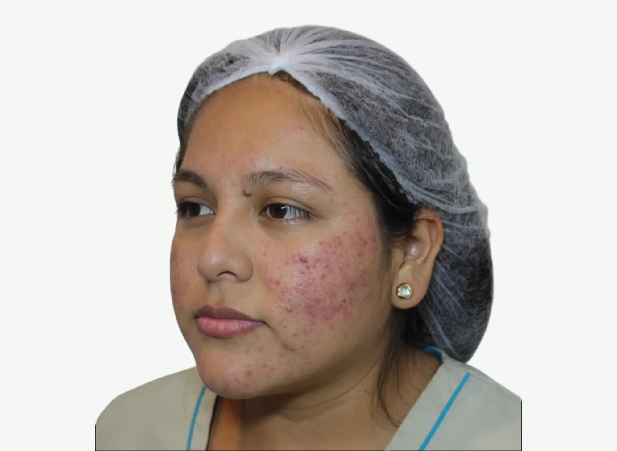 ozonoterapia-A