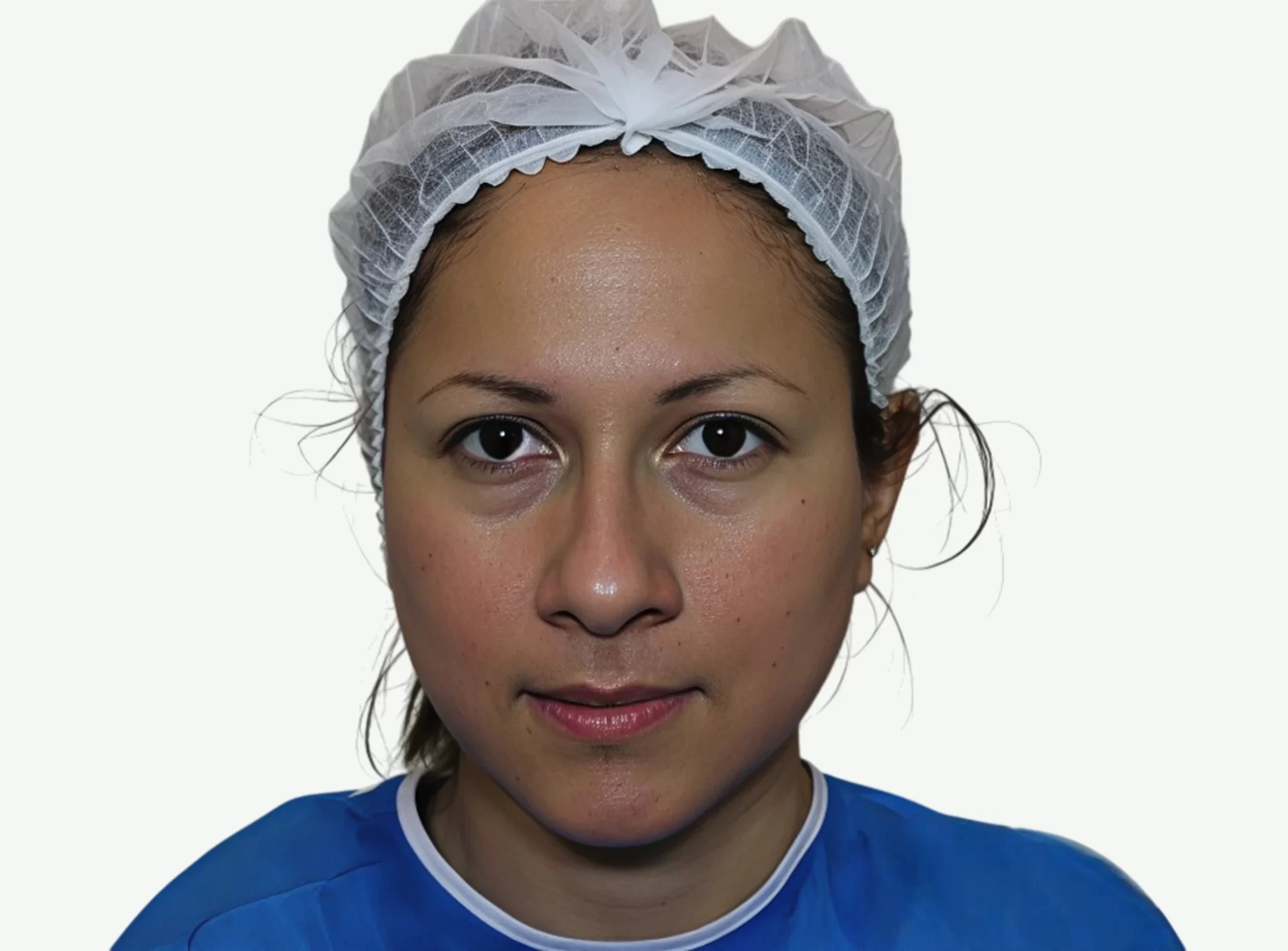 secuelas-de-acne-D