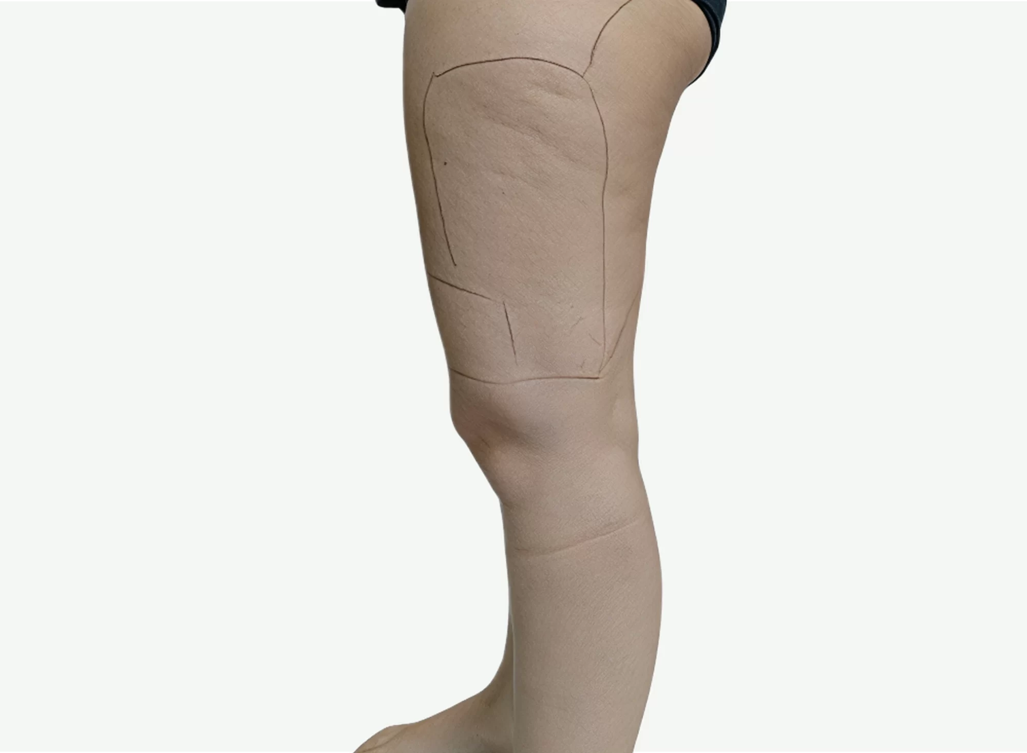celulitis-antes