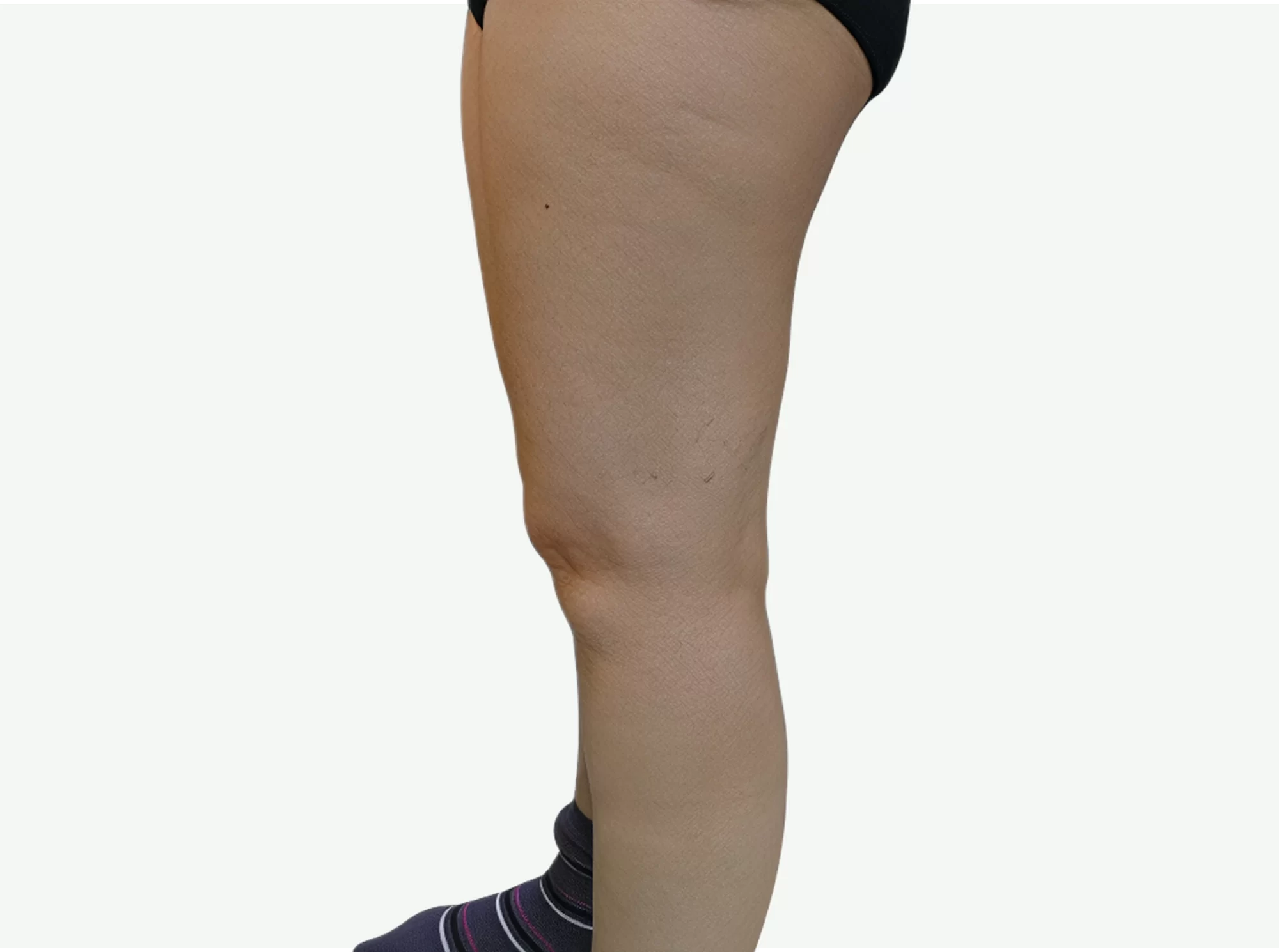 celulitis-despues